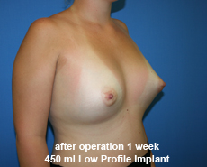 plastic-surgery-breast-augmentation